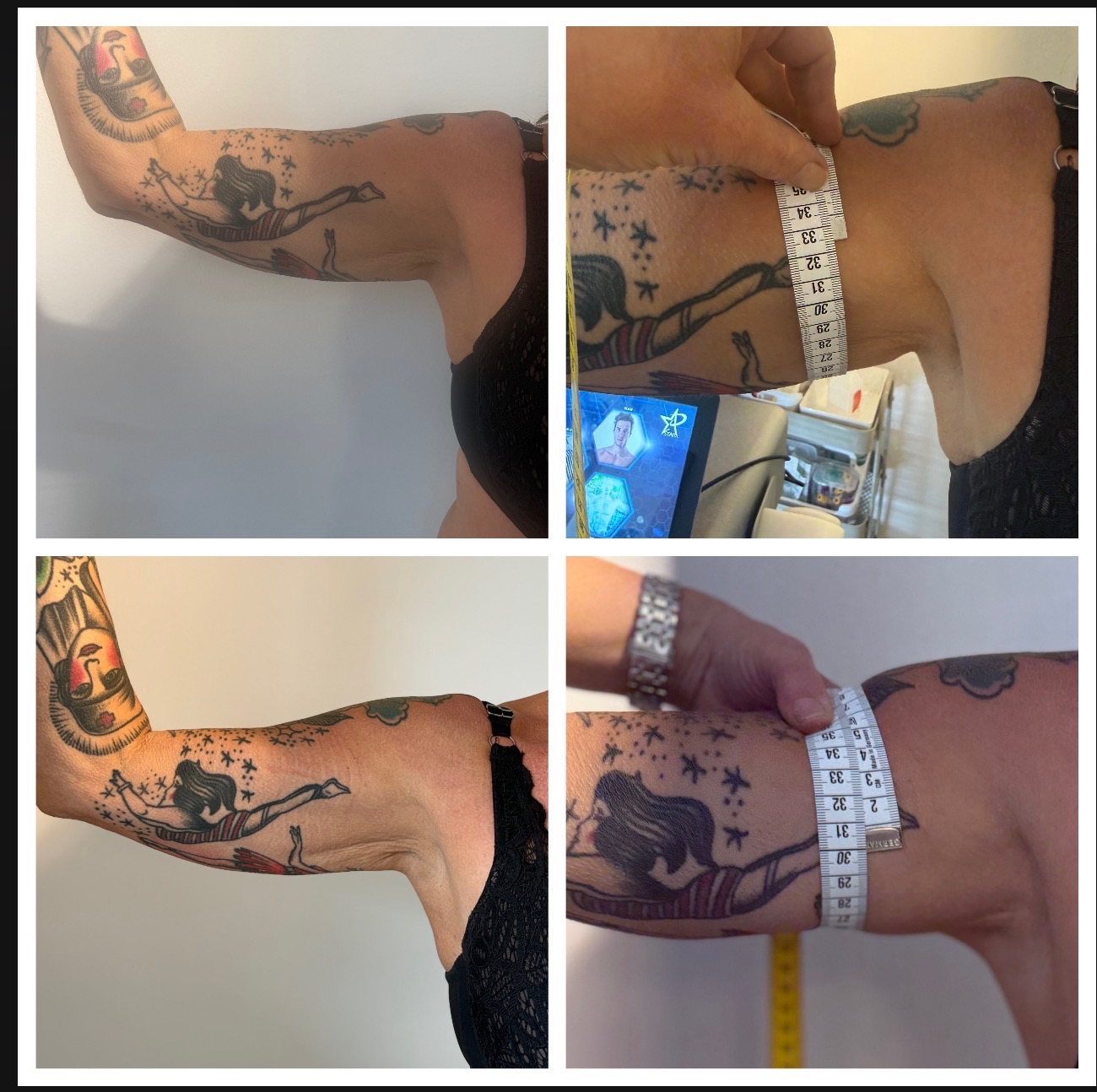 Fettfrysning resultat, arm med måttband